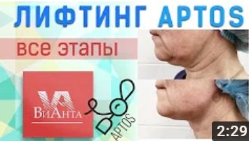 Лифтинг подбородочной области нитями APTOS